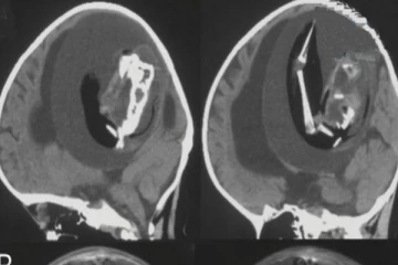 குழந்தையின் மூளைக்குள் இருந்து இரட்டை குழந்தையை அகற்றிய மருத்துவர்கள்!