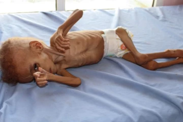 මන්දපෝෂණය තුරන් කිරීමට රජයේ වෛද්‍ය නිලධාරින්ගේ සංගමයෙන් කරන්න යන විශේෂ දේ