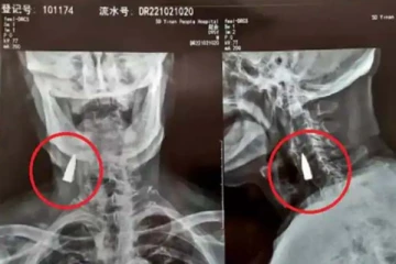 கழுத்தில் 80 ஆண்டுகளாக இருந்த துப்பாக்கி தோட்டா! எக்ஸ்ரேவில் கிடைத்த ஷாக்