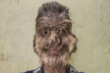 உடல் முழுவதும் ரோமங்கள்… மக்கள் கல்லால் அடித்தும் தன்னம்பிக்கையை இழக்காத இளைஞர்!