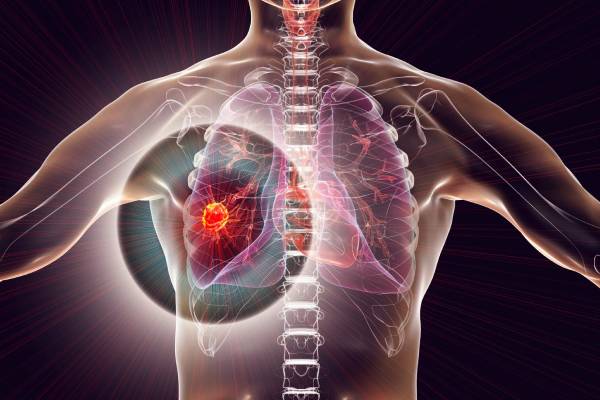 மிகவும் ஆபத்தான புற்றுநோய் எது? எத்தனை சதவீதம் உயிர் வாழலாம்? | Most Dangerous Cancer How Many Years Can You Live மிகவும் ஆபத்தான புற்றுநோய் எது? எத்தனை சதவீதம் உயிர் வாழலாம்? | Most Dangerous Cancer How Many Years Can You Live