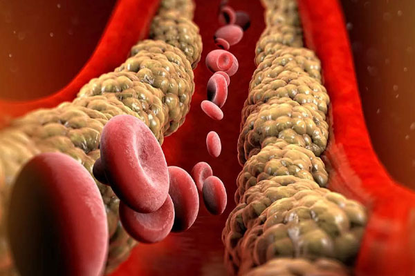 கொலஸ்ட்ராலை கரைக்கும் நீர் | Water Dissolves Cholesterol