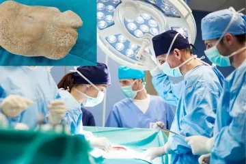 சிறுவனின் சிறுநீர்ப்பையில் இருந்த தேங்காய் அளவிலான 1 கிலோ எடை கொண்ட கல்! வெளியான புகைப்படம்