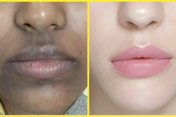 வாயை சுற்றி கருமையை உள்ளதா? இதனை எப்படி போக்கலாம்?