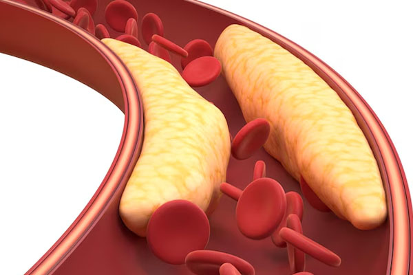 Fat in blood vessels