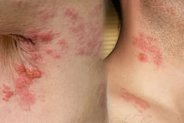 அக்கி நோய் ஏற்பட காரணங்களும் சிகிச்சையும்!