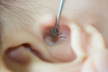 காதுக்குள் பூச்சி நுழைந்து விட்டதா? இந்த பிழையை செய்யாதீர்கள்… உடனடியாக செய்யவேண்டியது என்னென்ன?