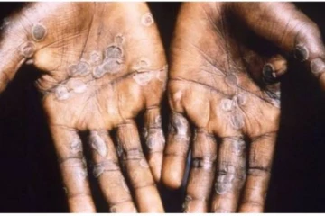 கவனம் தேவை... ஆசியாவிலும் நுழைந்த குரங்கு அம்மை!