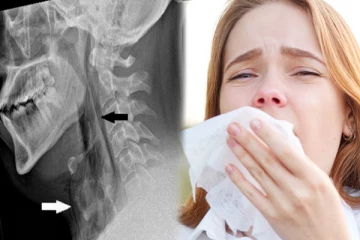 தும்மலை அடக்கியதால் நேர்ந்த சோகம்; இப்படி கூடவா நடக்கும்..? மருத்துவர்கள் அதிர்ச்சி!