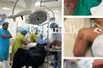 වෙන් වූ අතක් යළි සවි කළ විශ්මිත සැත්කම. (PHOTOS)