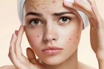 ஒரே இரவில் உங்கள் முகப்பருக்களை நீக்க வேண்டுமா? சூப்பரான டிப்ஸ் இதோ உங்களுக்காக!