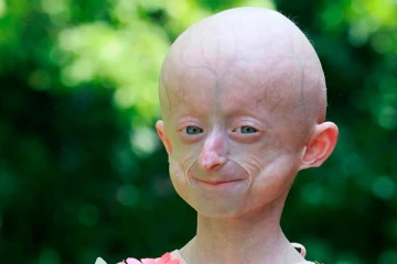 80 வயது தோற்றம்... அரியவகை நோய்: 10 வயதில் பரிதாப மரணம்