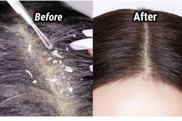 பொடுகு தொல்லை அதிகம் இருக்கா? இதை மட்டும் செய்திடுங்கள்