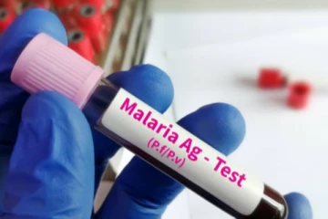 கானாவிலிருந்து கிளிநொச்சி வந்தவருக்கு மலேரியா