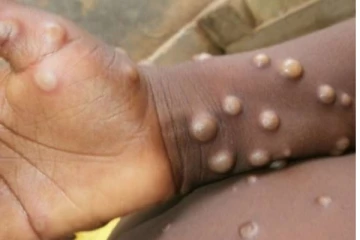 குரங்கு அம்மையை தடுக்க விமான நிலையங்களில் மத்திய அரசு அதிரடி நடவடிக்கை