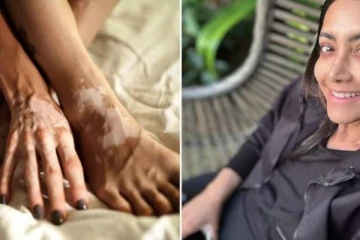 கொஞ்சம் கொஞ்சமாக நிறத்தை இழக்கும் பிரபலம்! அரிய வகை நோயால் பாதிப்பு