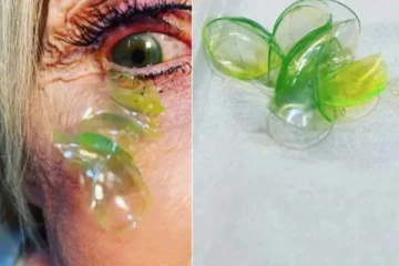 பெண்ணின் கண்ணிலிருந்து எடுக்கப்பட்ட 23 Contact Lenses! நடந்தது என்ன?