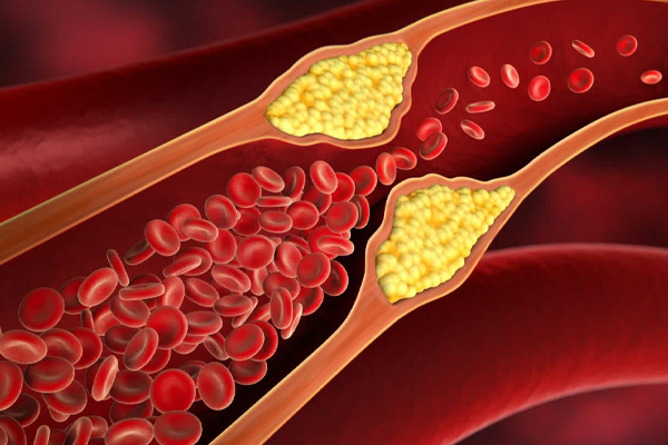 மரணத்தை ஏற்படுத்தும் கொலஸ்ட்ரால்! | Cholesterol Causes Death
