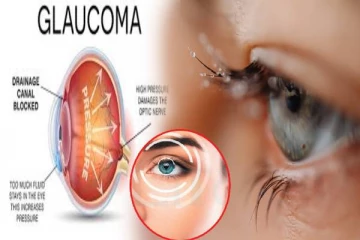 glaucoma symptoms: கண் நீர் அழுத்த நோய் ஏன் ஏற்படுகின்றது? அறிகுறிகளும் தீ்ர்வும்