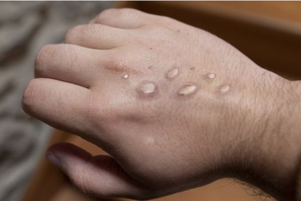 புதுக்கோட்டை மாவட்டத்தில் ஒருவருக்கு குரங்கு அம்மை? | Monkey Measles In Pudukottai District