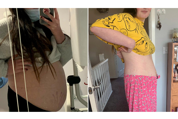 9 மாத கர்ப்பிணியாக கருதப்பட்ட இளம் பெண் வயிற்றிலிருந்து 13 அங்குல நீர்க்கட்டி அகற்றப்பட்டது! | World Viral News