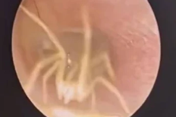 சீனாவில் பெண் ஒருவரது காதுக்குள் உயிருடன் இருந்த சிலந்தி