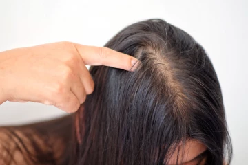 சொட்டை விழுகிறதா? உடனே தடுக்க இந்த ஒரே ஒரு பொருள் போதும்