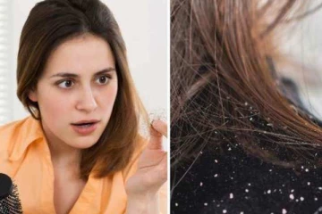 என்ன பண்ணினாலும் பொடுகு போகலையா? அடித்து விரட்டும் ஆயுர்வேத வைத்தியம்