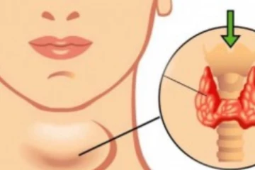 தைராய்டு நோயை குணப்படுத்துவது எப்படி?