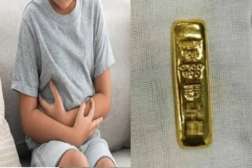 சிறுவனின் வயிற்றில் இருந்த 100 கிராம் தங்கக்கட்டி - அதிர்ச்சியில் மருத்துவர்கள்