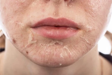 உங்கள் முகத்தில் தோல் உரியுதா? இதனை போக்க இவற்றை பின்பற்றினாலே போதும்!