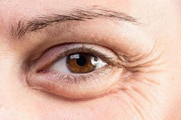 கண்ணுக்கு கீழ் வீக்கமா? பட்டுனு சரியாக இதோ சில எளிய வழிகள்