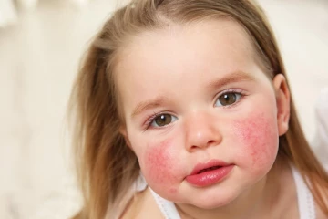 இந்த 5 உணவுகளை சாப்பிடுங்க உங்களுக்கு அலர்ஜியே வராதாம்!!