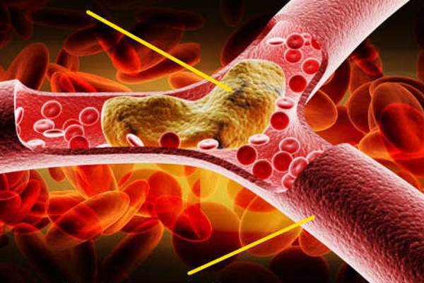கொலஸ்ட்ரால் உள்ளவர்கள் வேர்க்கடலை உண்ணலாமா! | Can People With Cholesterol Eat Peanuts
