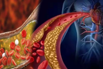 கொலஸ்ட்ரால் நோய் வருவதற்கு இதுதான் காரணம்! இதை மட்டும் பண்ணாதீங்க