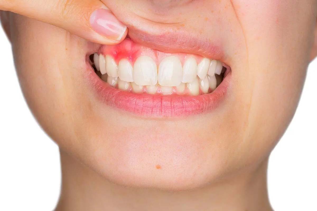 பற்களை பாதுகாக்க இயற்கையான வீட்டு வைத்தியம் தெரியுமா? | Tips To Keep Your Tooth Healthy