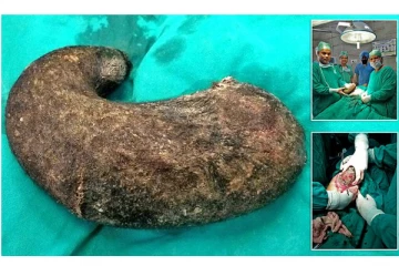 15 வயது மாணவி வயிற்றில் 1 கிலோ எடையுள்ள முடிகளால் ஆன கட்டி அகற்றம்!