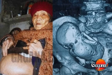 වසර 61 ක් මියගිය දරුවා කුස තුළ රදවා සිටි මව.ඇඟ හිරිවැටෙන කතාවක්