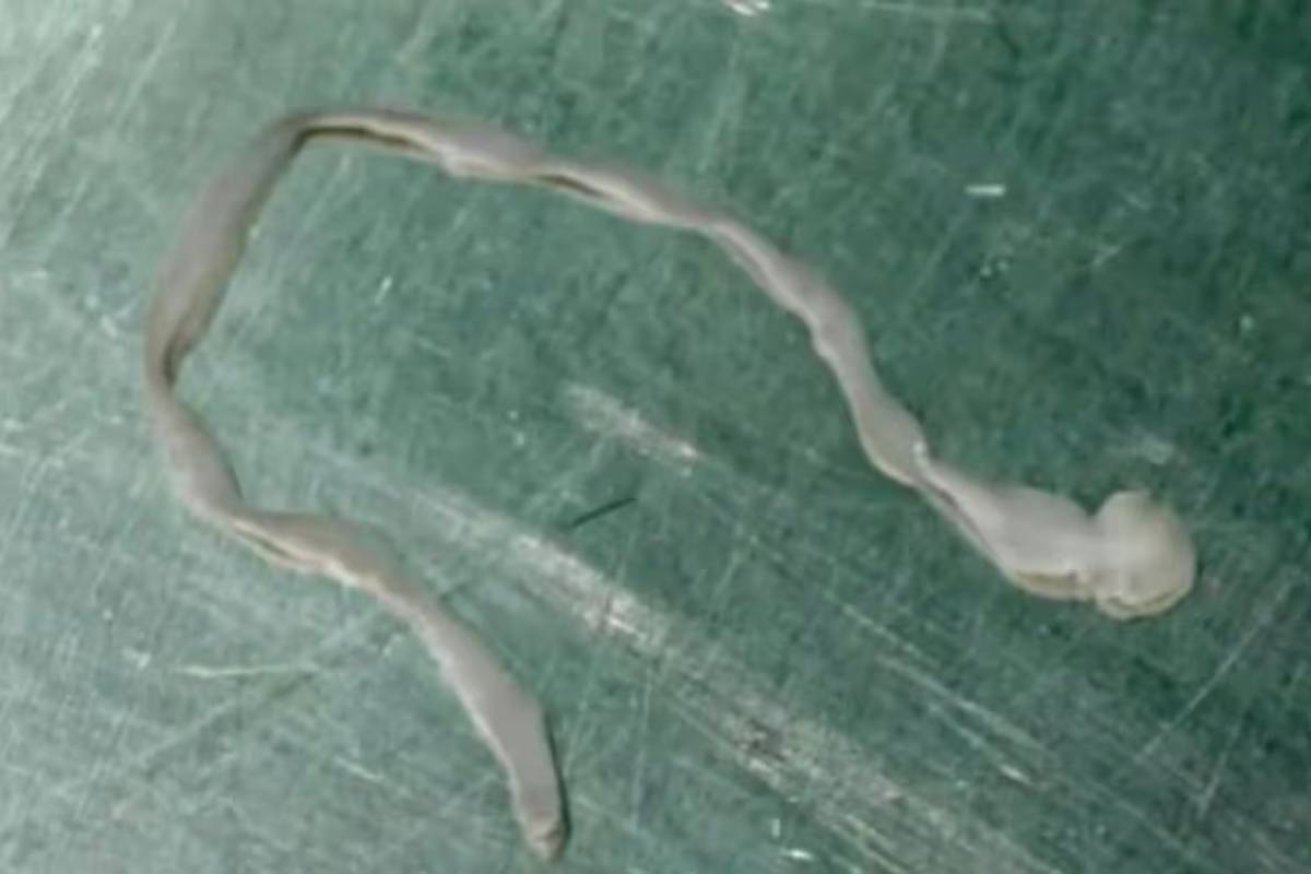 பல ஆண்டுகளாக உடல் நலம் பாதிக்கப்பட்டிருந்த பெண்: தெரியவந்த திடுக்கிடவைக்கும் உண்மை | Doctors Found 8Cm Worm Inside Women Brain In China