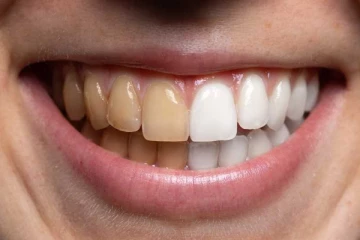 பற்களின் மீது உள்ள கறைகள் எளிய முறையில் நீக்க வேண்டுமா? இதோ சில எளிய வீட்டு வைத்தியங்கள் உங்களுக்காக..!