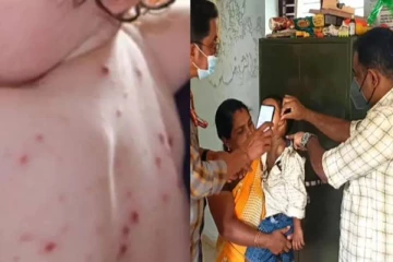 அச்சுறுத்தும் தக்காளி காய்ச்சல்! இந்த அறிகுறிகள் இருந்தால் அலட்சியம் வேண்டாம்