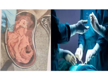 பெண்ணின் வயிற்றுக்குள் Surgical Mop.. பிரசவத்திற்காக சென்ற பெண்ணுக்கு நேர்ந்த கொடூரம்!