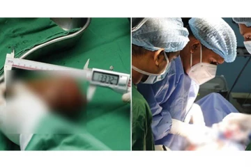 801 கிராம் எடை கொண்ட மிகப்பெரிய சிறுநீரக கல் - இலங்கை மருத்துவர்கள் உலக சாதனை!