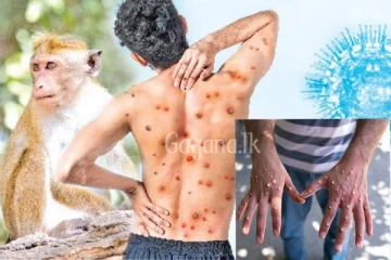 වඳුරු උණ රෝගීන් දෙදෙනෙක් මෙරටින් හමුවෙයි..භයානක තත්ත්වයක්..