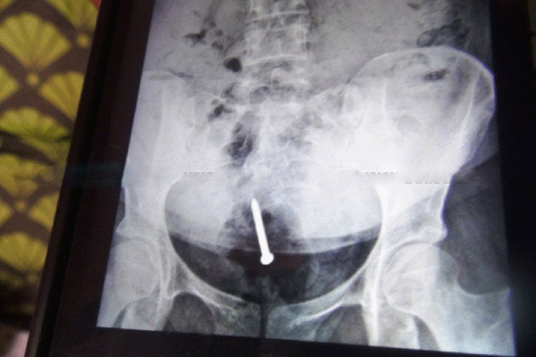 சவுதியில் கொடூரம்: ஆணிகளை விழுங்க வைக்கப்பட்ட இலங்கை பெண் (படங்கள்) | Saudi Sri Lankan Woman Made To Swallow Nails