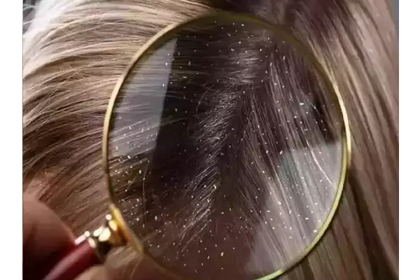 கூந்தல் பிரச்சனைக்கு முற்றுப்புள்ளி வைக்குமா இளநீர்! | Does It Provide A Permanent Solution To Hair Loss