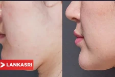 உங்களுக்கு கீழ் தாடை ரொம்ப பெருசா இருக்கா? ... இந்த இரட்டை நாடியை எப்படிக் குறைக்கலாம்?