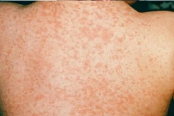 நாட்டில் அதிகரித்து வரும் தட்டம்மை நோய்; விடுக்கப்பட்டுள்ள எச்சரிக்கை