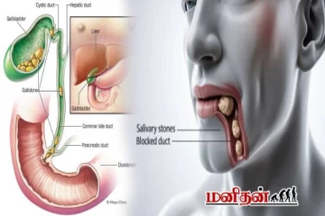சிறுநீரகத்தில் மட்டுமல்ல இந்த 4 இடத்திலும் கற்கள் உருவாகும் - எங்கு தெரியுமா?