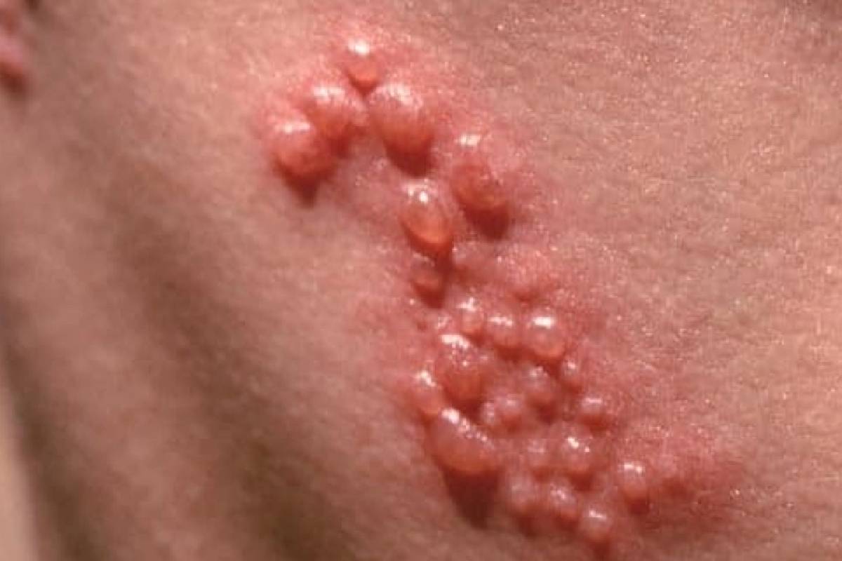 வெயில் காலத்தில் தோலில் வரும் அக்கி நோய் - டாக்டர் கார்த்திகேயன் விளக்கம் | Shingles Disease Dr Karthikeyan S Explanation